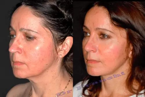 Photos avant et après un lifting cervico-facial