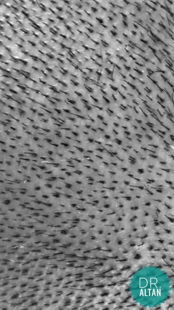 fue hair transplant