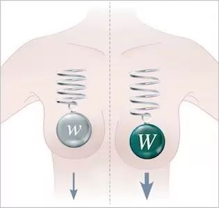 zväčšení pŕs s B-lite implantátami