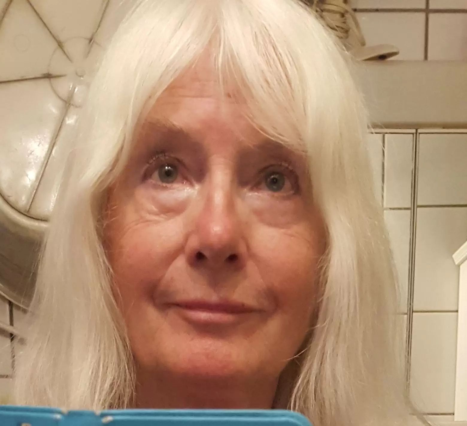 Vorher, nachher Fotos zur Entfernung von Malar Bags Unterlidstraffung (Tränensäcke Entfernen