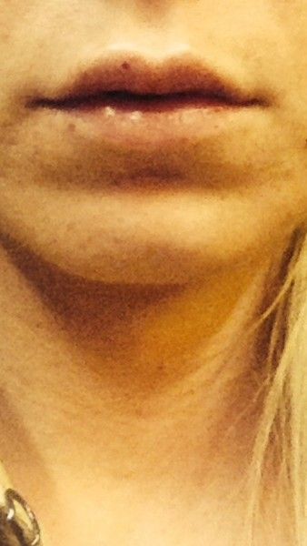 Extreme Schwellung Nach Lippen Aufspritzen Injizierbare Fullstoffe Dysport Restylane Botox Bio Alcamid Forum Estheticon De