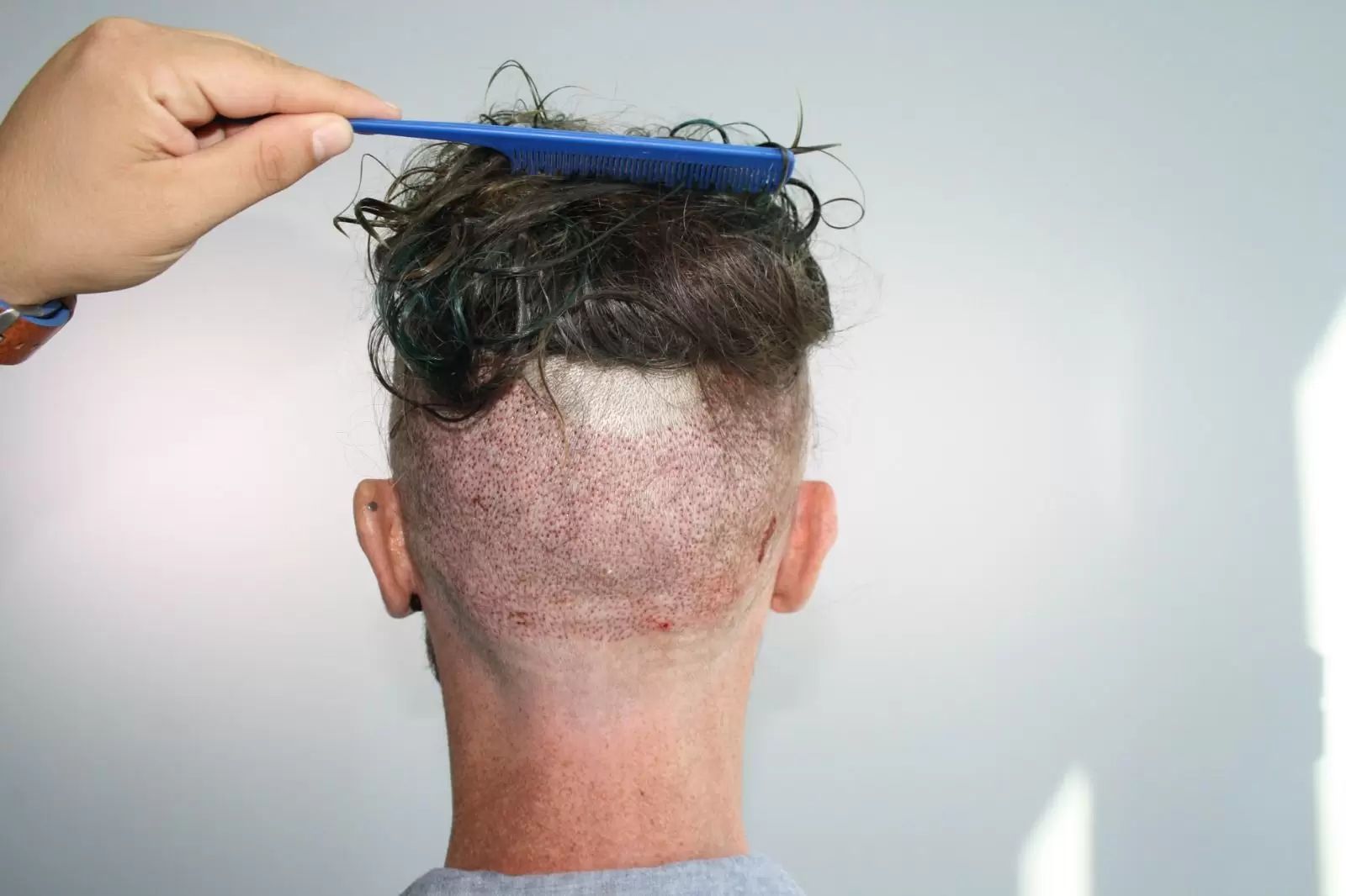 FUE - Haartransplantation mit Teilrasur: 3.264 Grafts | Estheticon.de