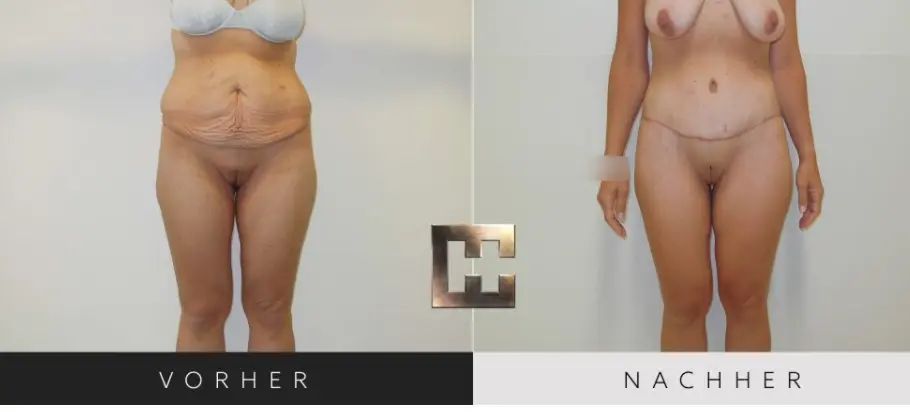 bodylift huemer b