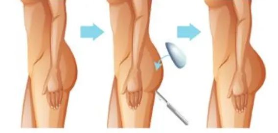 gesäßimplantat