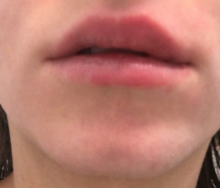 Ungleichmassige Lippen Nach Unterspritzung Mit 0 5 Ml Vor 2 Tagen Lippenvergrosserung Mit Hyaluronsaure Forum Estheticon De