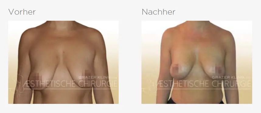straffung