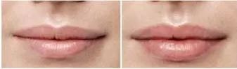 Augmentation du volume de la levre supérieure supérieure