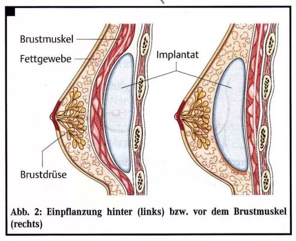 Implantat UBM vs ÜBM