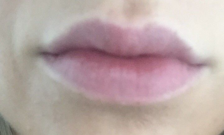 Knubbel Nach Unterspritzung Mit Hyaluronsaure Lippenvergrosserung Mit Hyaluronsaure Forum Estheticon De