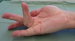 dupuytren3