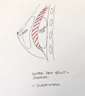 Implantat liegt unter dem Brustmuskel