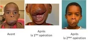 chirurgie répatrice la naissance