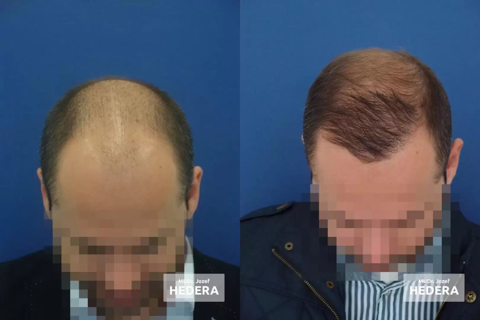 Pred po fotky, výsledok po transplantácii vlasov