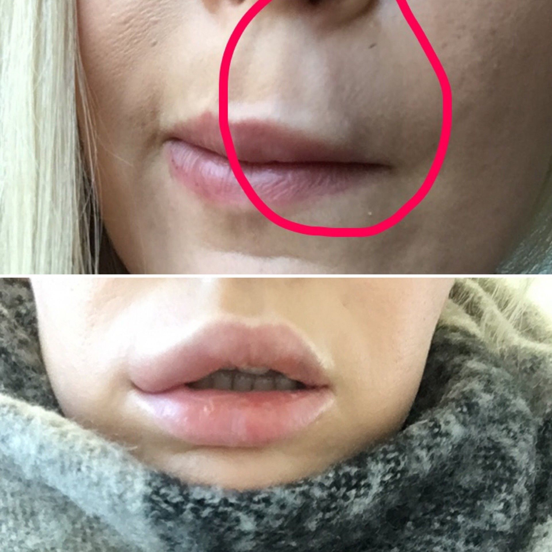 Auflosung Von Uma Jeunesse An Den Lippen Durch Hylase Lippenvergrosserung Mit Hyaluronsaure Forum Estheticon De