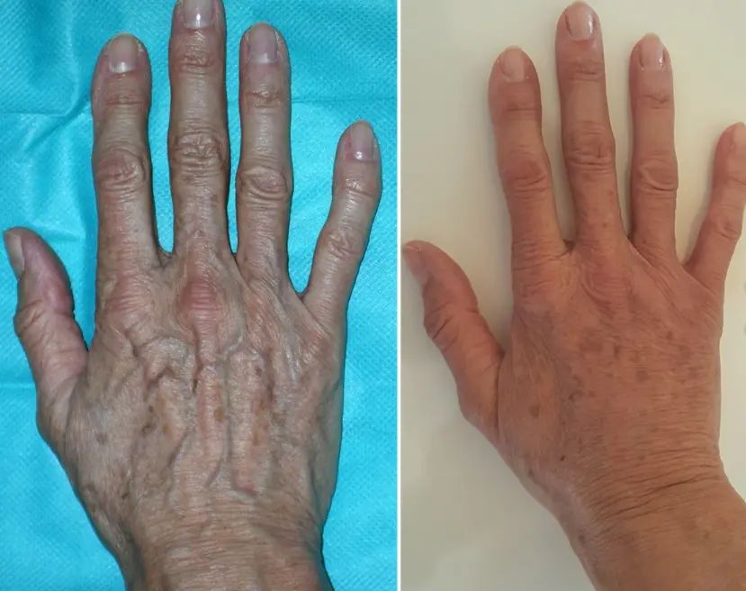 handverjüngung redkenbacher