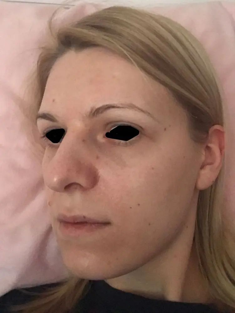 Ist Diese Nase Zu Retten Komplizierte Nase Nasenkorrektur Rhinoplastik Forum Estheticon De