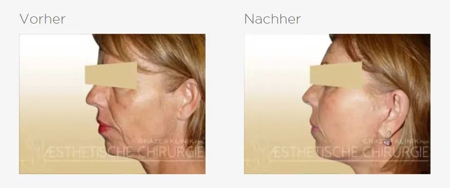 facelif