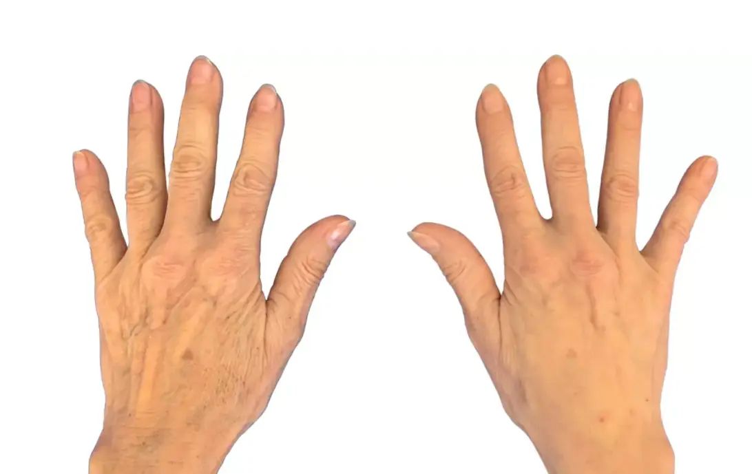 handverjüngung bartsch