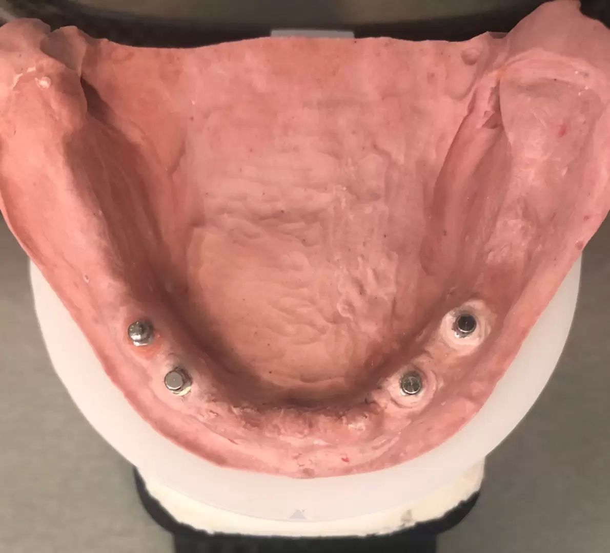 model s miniimplantátmi