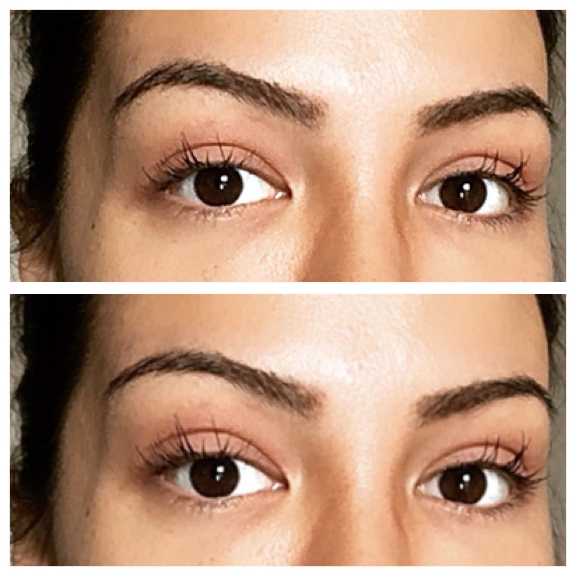 Leichte Veränderung der Augenform Oberlidkorrektur Schlupflidkorrekur Forum Estheticon.de