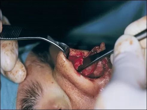 rinoplastika3