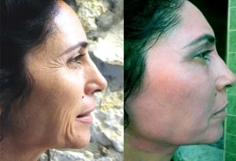 exoderm peel