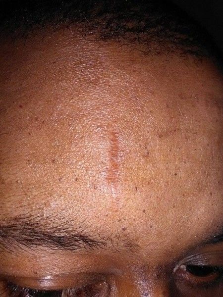 Faire Disparaitre Une Cicatrice Et Une Tache Noire Sur Le Front Retirer Cicatrice Traitement Cicatrice Laser Forum Estheticon Fr