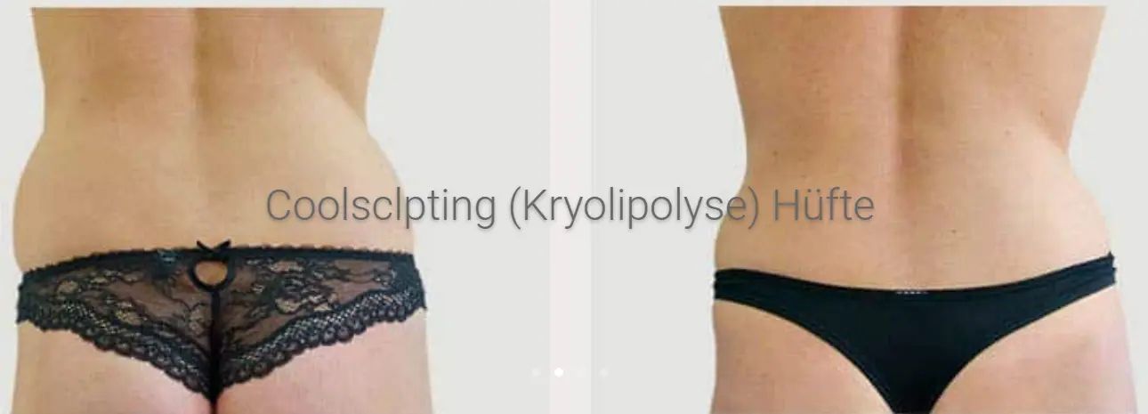 cryolip 1
