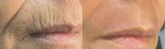 omladenie pleti frakčným CO2 laserom