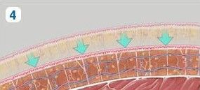 liposukce6