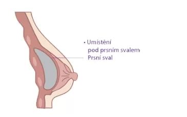 vložení prsního implantátu pod sval