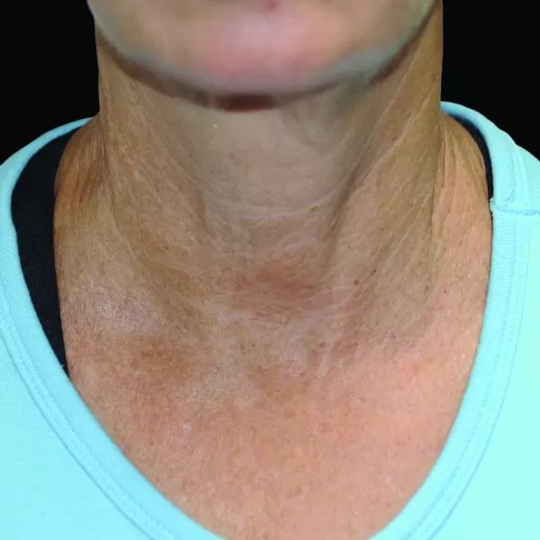 Exilis Elite PIC B&A 010 After2TX