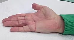 dupuytren1
