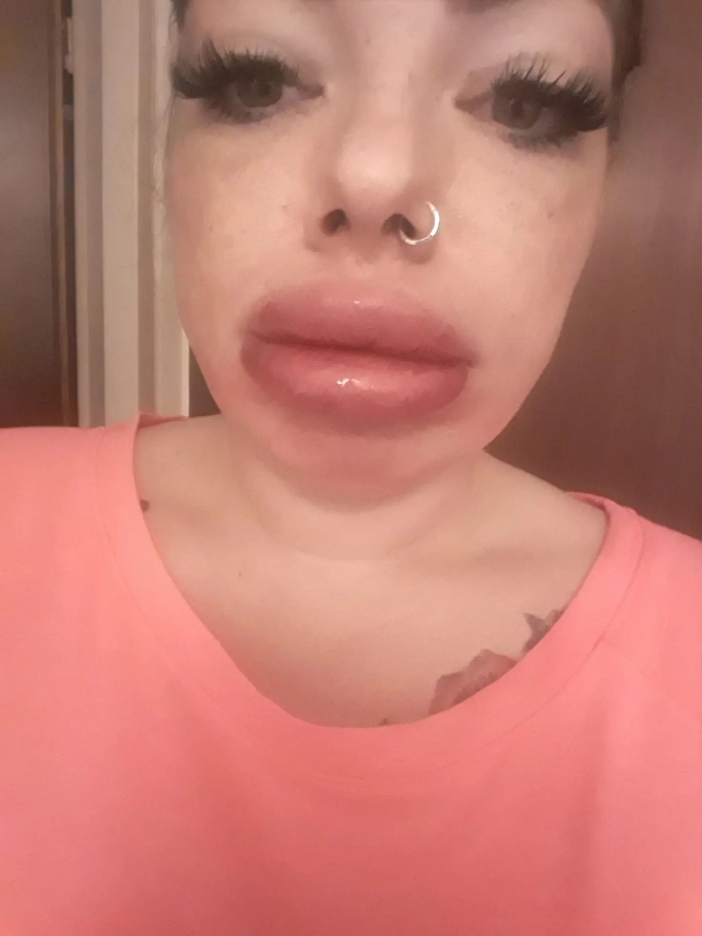 Verpfuschte Lippen Durch Kosmetikerin Was Tun Injizierbare Fullstoffe Dysport Restylane Botox Bio Alcamid Forum Estheticon De