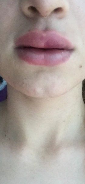 Lippen Aufgespritzt Mit 0 5ml Hyaluronsaure Lippenvergrosserung Mit Hyaluronsaure Forum Estheticon De