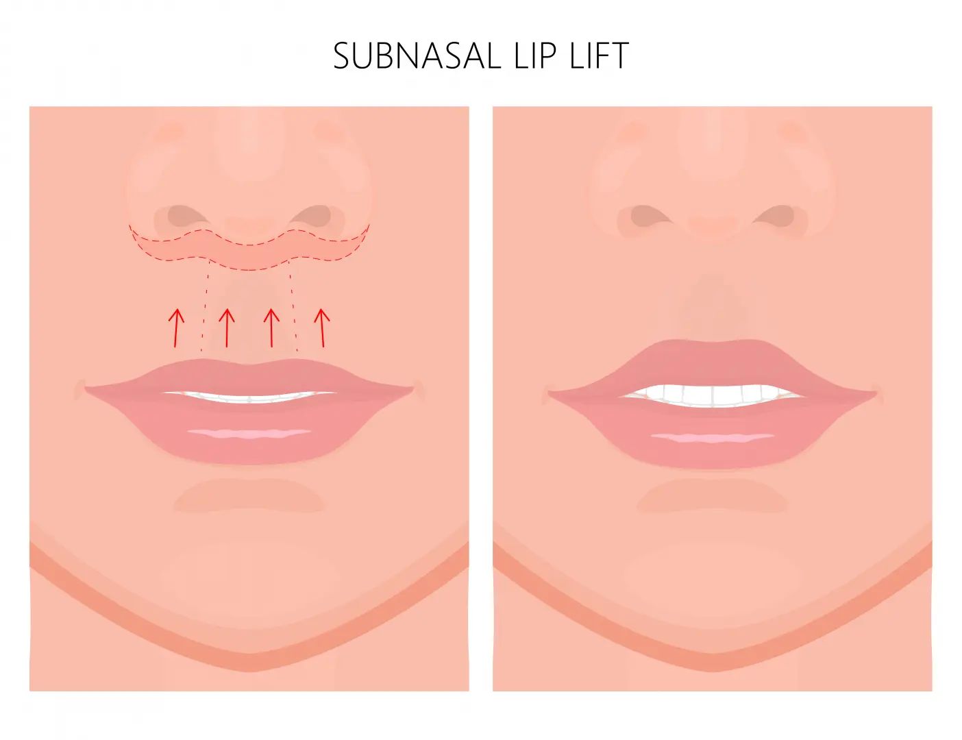 bullhorn lips