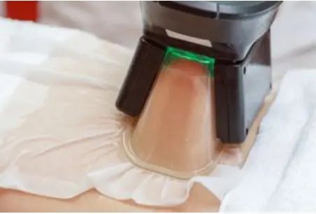 cryolip 2