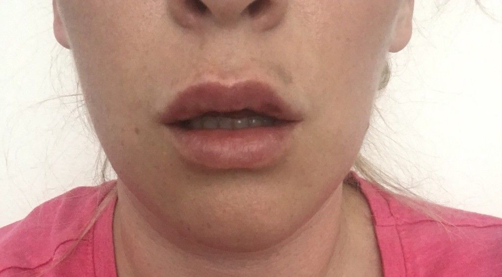 Lippe Blau Und Schief Nach Behandlung Mit Hyaluron Lippenvergrosserung Mit Hyaluronsaure Forum Estheticon De