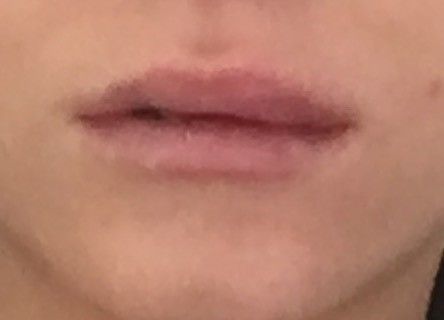 Ungleichmassige Lippen Nach Unterspritzung Mit 0 5 Ml Vor 2 en Lippenvergrosserung Mit Hyaluronsaure Forum Estheticon De