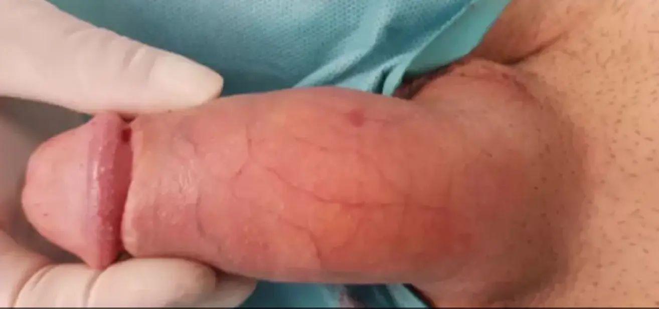penisverdickung spanholzt