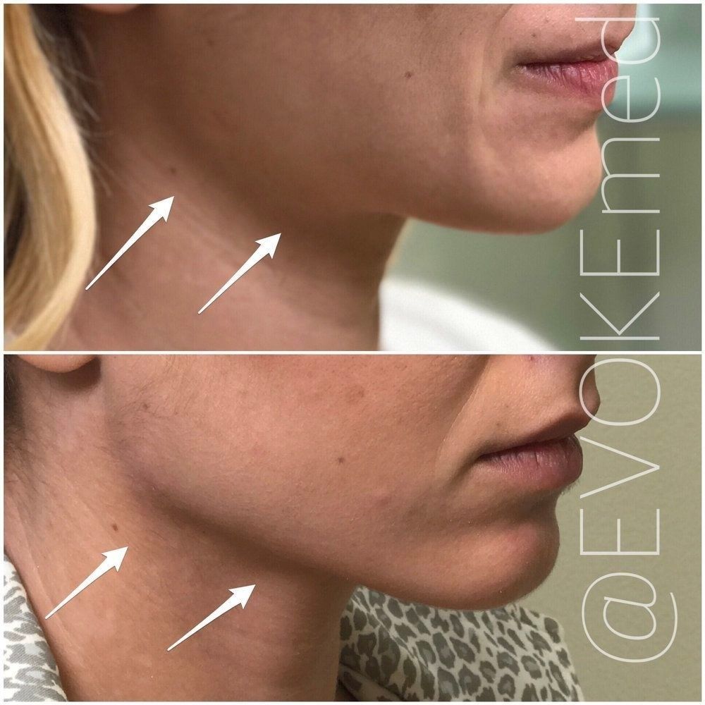 Que Faire Après Avoir Raté 2 Année De Médecine Injections acide hyaluronique machoire en Belgique / Jawline contouring