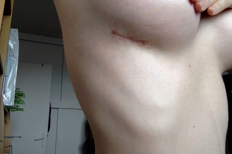 cicatrices implants mammaires cicatrices implants mammaires