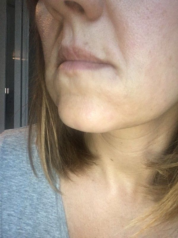 Schwellungen In Den Unteren Backen Nach Unterspritzung Der Mundwinkelfalten Injizierbare Fullstoffe Dysport Restylane Botox Bio Alcamid Forum Estheticon De