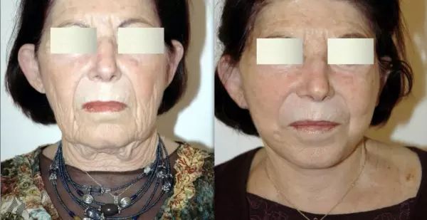 09 Résultat lifting cervico facial