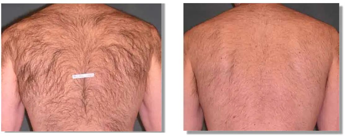 laser haar