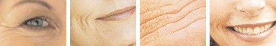 botox2
