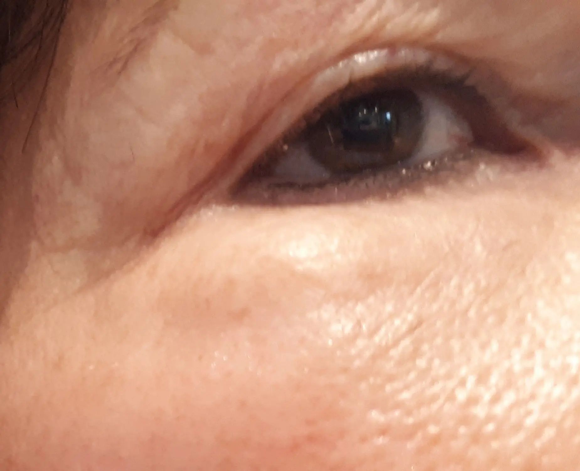 Augenringe Mit Eigenfett Unterspritzt Injizierbare Fullstoffe Dysport Restylane Botox Bio Alcamid Forum Estheticon De
