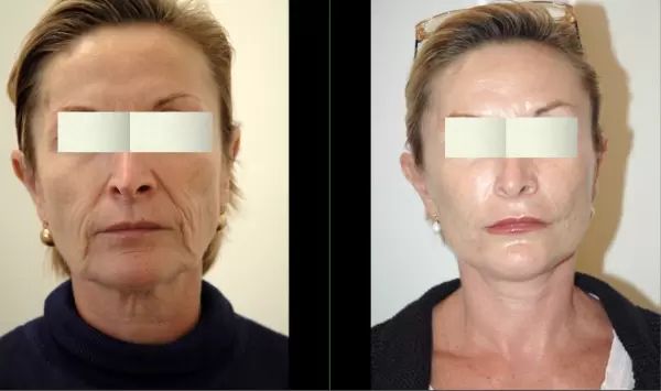 14 Résultat Lifting Composite