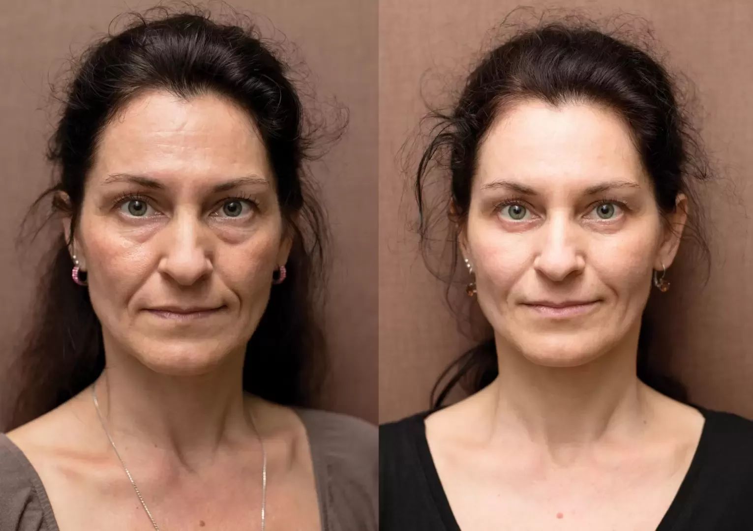 hydratace pleti, foto před a po ošetření Skinboosterem