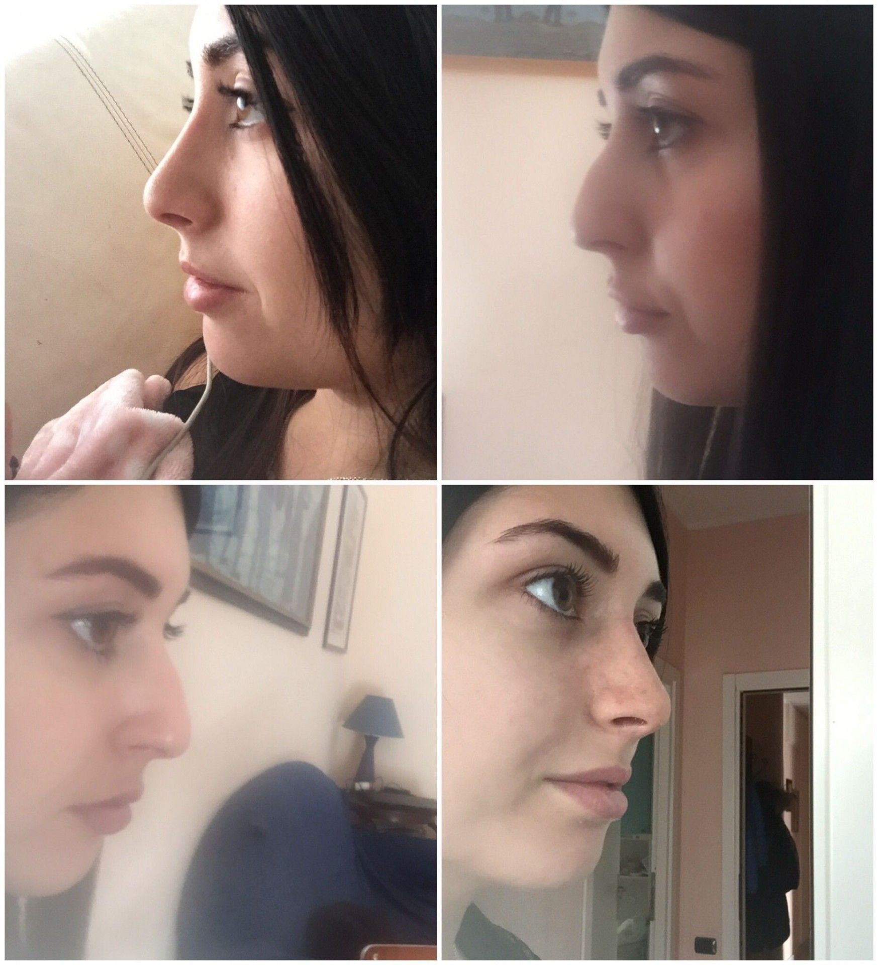 Supratip Post Rinoplastica E Punta Cadente Operazione Plastica Naso Rinoplastica Forum Estheticon It